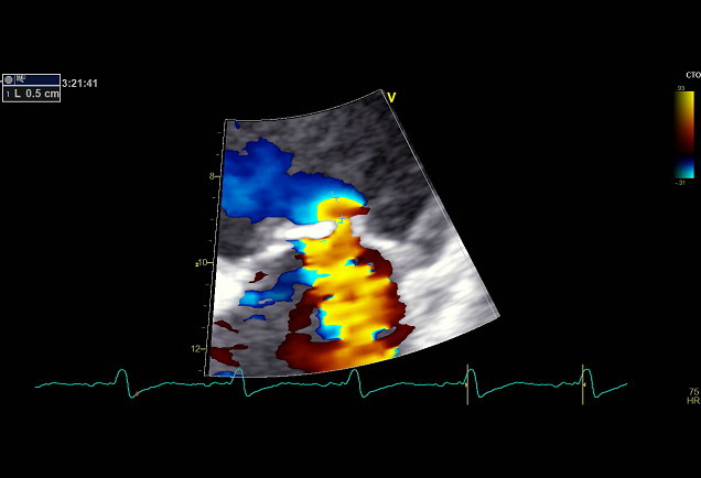 Figure 1: ERO and MR volume assessed by PISA method.